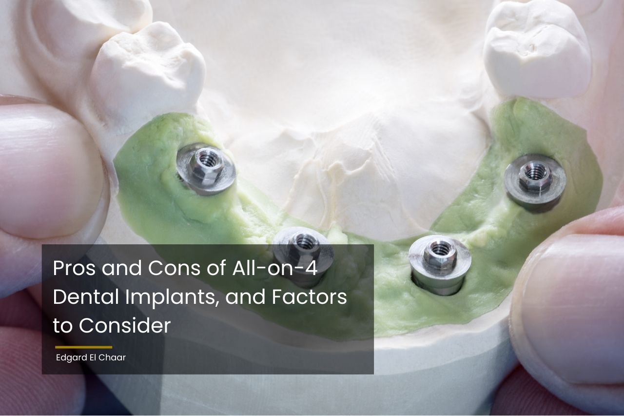 Pros And Cons Of All On 4 Dental Implants To Consider 7206